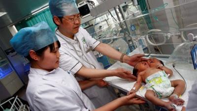 Siamesische Zwillinge In China Geboren Grenzecho